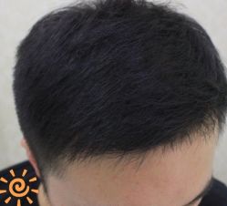 -大麦微针植发丨全国连锁