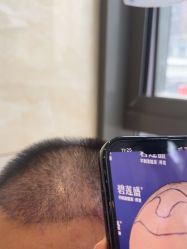 -碧莲盛·不剃发植发