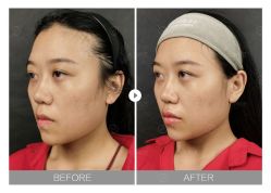 体验前-大华韩艺整形美容医院