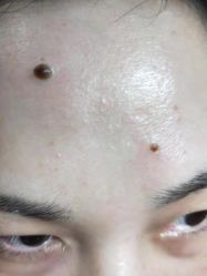 -美人痣全国连锁