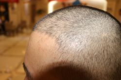 -大麦微针植发丨全国连锁