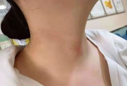 -北京美痣堂古方祛痣斑疣瘊