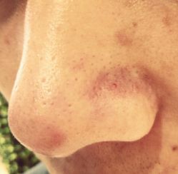 -成都苗方清颜专业祛痘