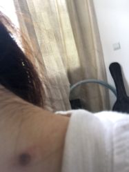 -爱莎扁平疣·汗管瘤·斑痣中心