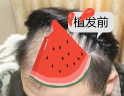 -大麦微针植发全国连锁