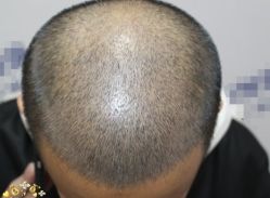 -大麦微针植发丨全国连锁