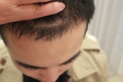 点击看大图 -大麦微针植发丨全国连锁