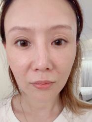 体验后-海涛医疗美容·面部抗衰·注射美鼻