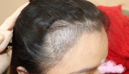 -大麦微针植发丨全国连锁