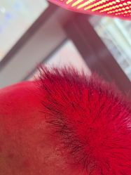 -碧莲盛·不剃发植发