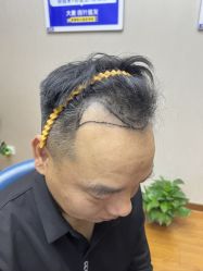 体验前-大麦微针植发全国连锁