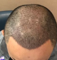 -大麦微针植发丨全国连锁