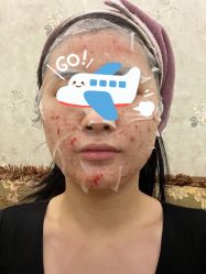 体验后-新美荟医美·专注面部美学抗衰
