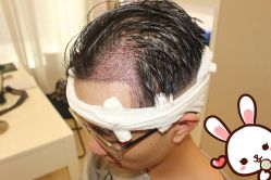 -大麦微针植发丨全国连锁