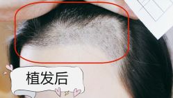 -大麦微针植发全国连锁