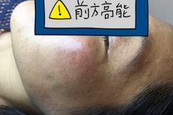 -爱莎扁平疣·汗管瘤·斑痣中心