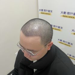 -大麦微针植发全国连锁