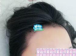 -大麦微针植发全国连锁