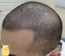 -大麦微针植发丨全国连锁