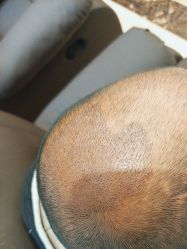 -碧莲盛·不剃发植发