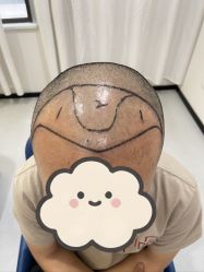 体验前-大麦微针植发全国连锁