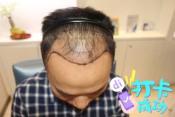 -大麦微针植发全国连锁