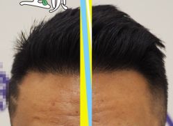 -大麦微针植发全国连锁