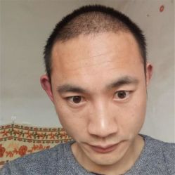-碧莲盛·不剃发植发
