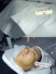 -悟空祛痘·诺奖技术专业店