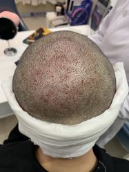 -大麦微针植发全国连锁