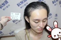 点击看大图 -大麦微针植发丨全国连锁