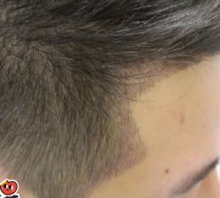 -大麦微针植发丨全国连锁
