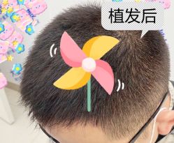 -大麦微针植发全国连锁