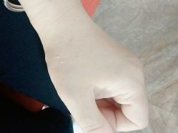 -痣清宫祛斑祛痣连锁店