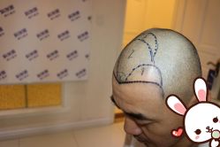 点击看大图 -大麦微针植发丨全国连锁