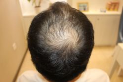 -大麦微针植发丨全国连锁