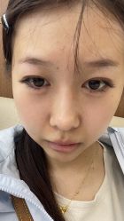 体验后-深圳艺星医疗美容医院