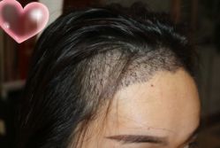 -大麦微针植发丨全国连锁