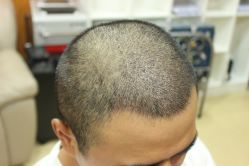 点击看大图 -大麦微针植发丨全国连锁