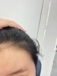 -大麦微针植发全国连锁