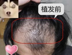 -大麦微针植发丨全国连锁