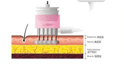 -海涛医疗美容·面部抗衰·注射美鼻