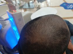 -碧莲盛·不剃发植发