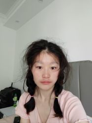 体验后-大麦微针植发丨全国连锁