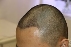 -大麦微针植发全国连锁