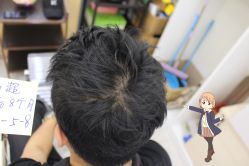 -大麦微针植发丨全国连锁