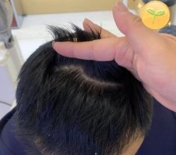 -大麦微针植发丨全国连锁