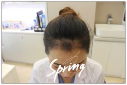 -大麦微针植发全国连锁