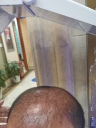 -碧莲盛·不剃发植发