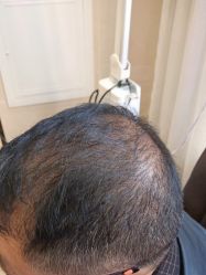 -碧莲盛·不剃发植发